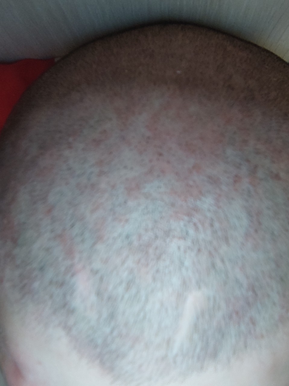 шелушение кожи груди у мужчин фото 37