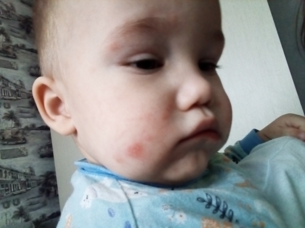 Пятно на лице ребёнка обмодоронгин