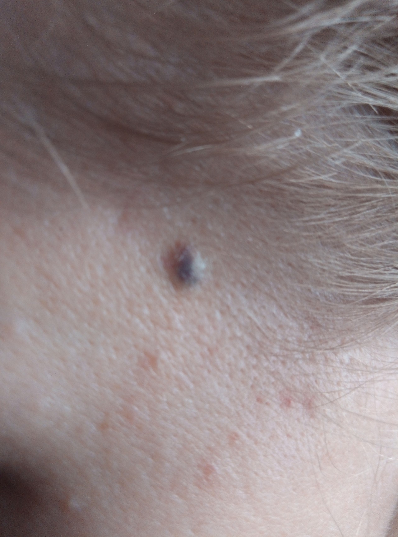 Темно синее, практически чёрное пятно под кожей - Вопрос дерматологу - 03  Онлайн