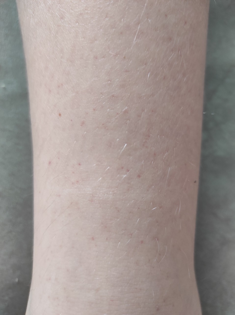 Аллергические пятна на ногах фото