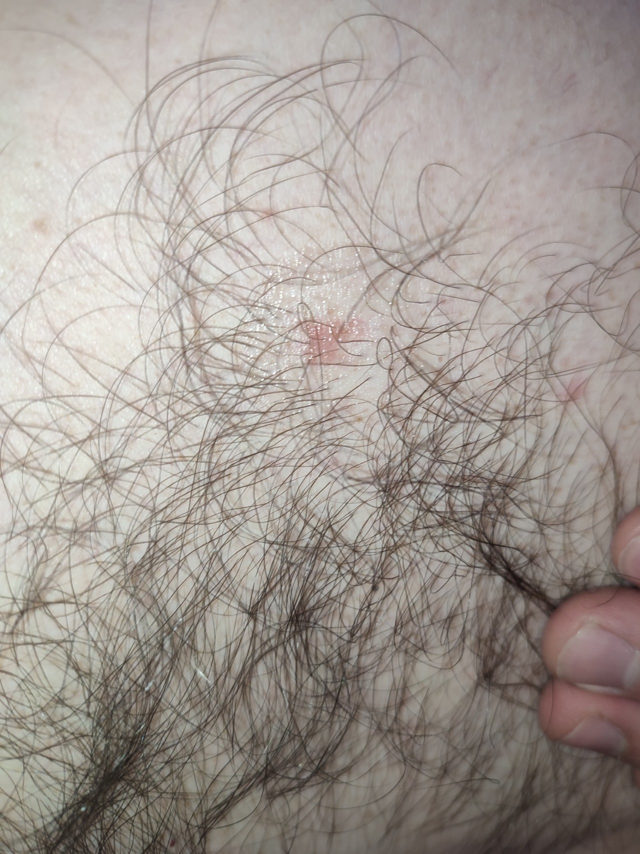шелушение кожи на груди у мужчин фото 35