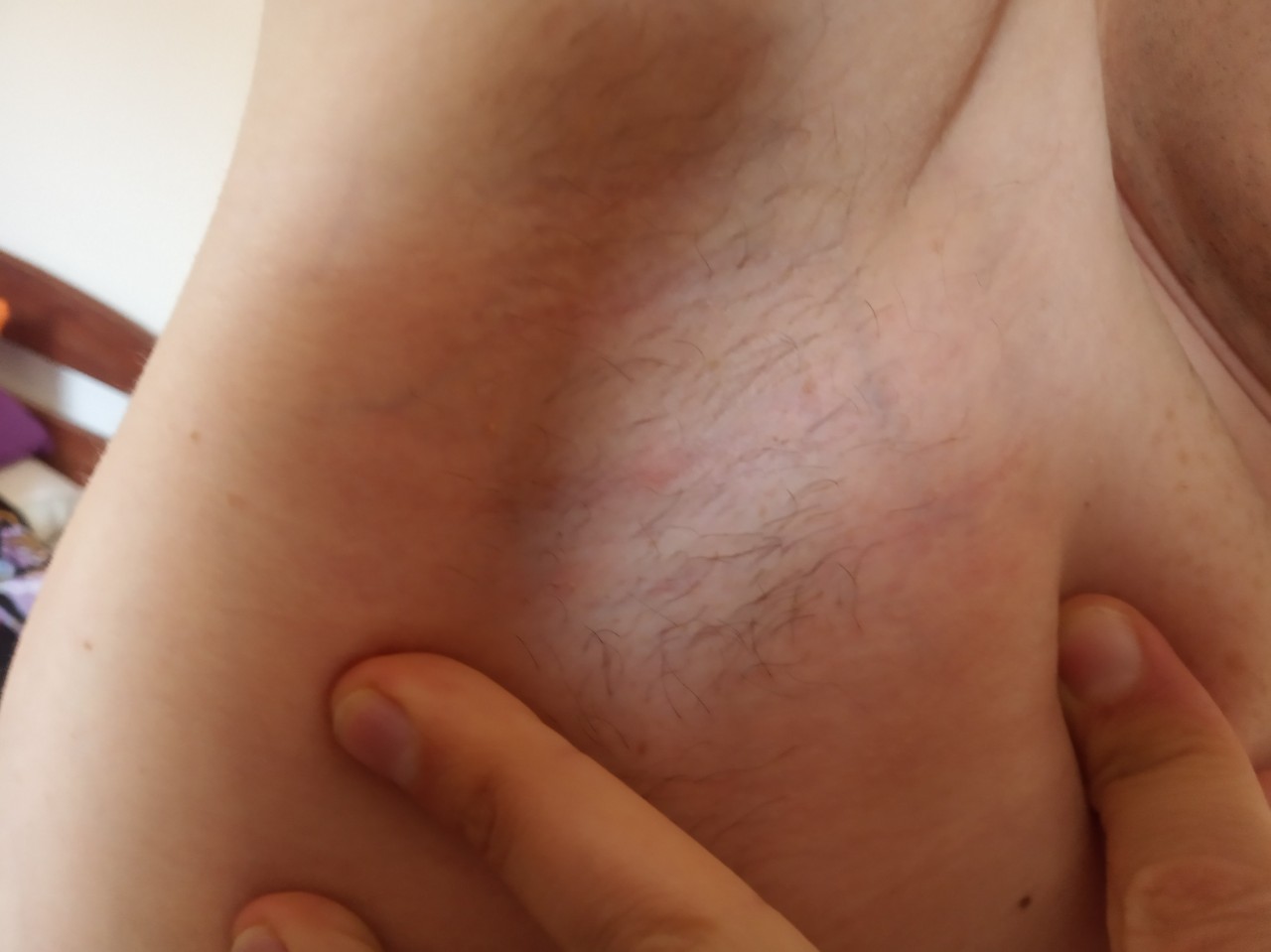 уплотнение под кожей в груди у мужчин фото 20