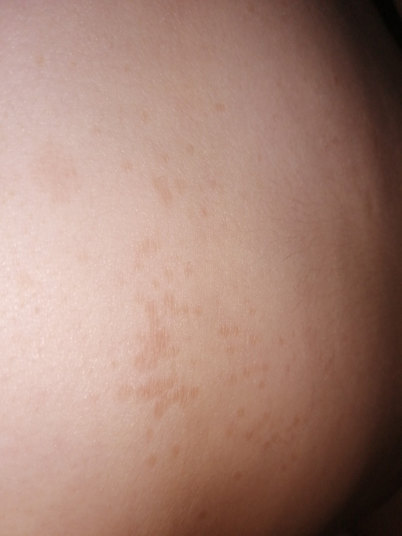 светло коричневые пятна на груди у женщин фото 44