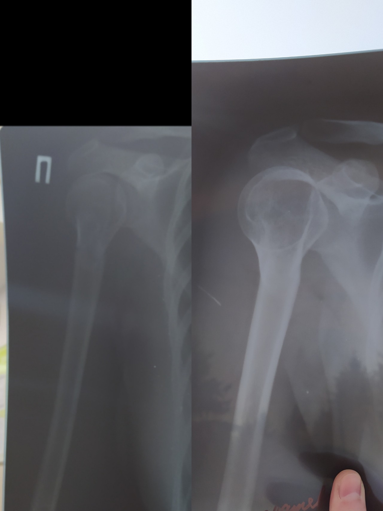 Субкапитальный перелом плеча. Периимплантный перелом плеча. Перелом плеча у ребенка 3 лет. Перелом плеча пластина