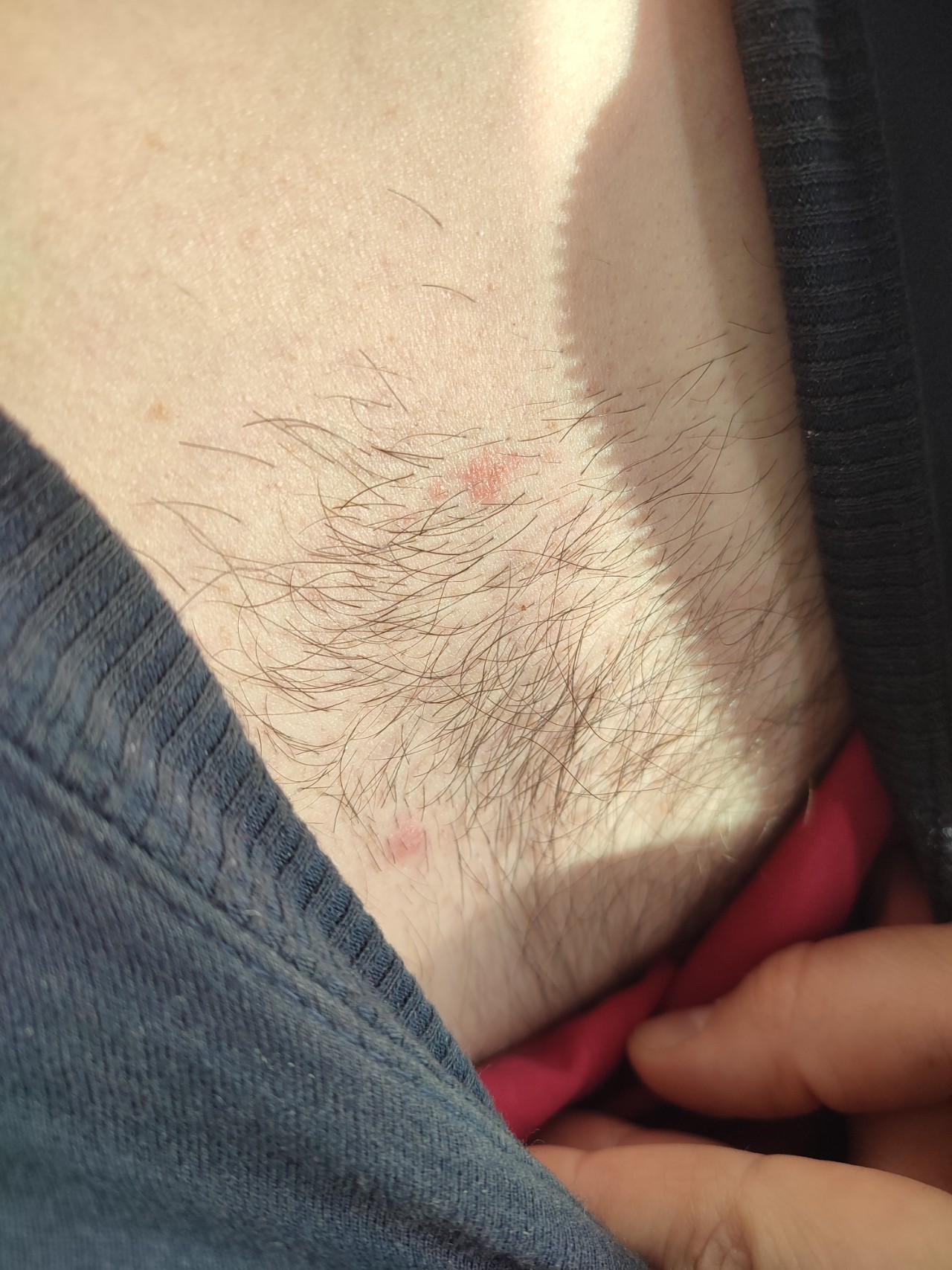 красная сыпь на груди во время беременности фото 39