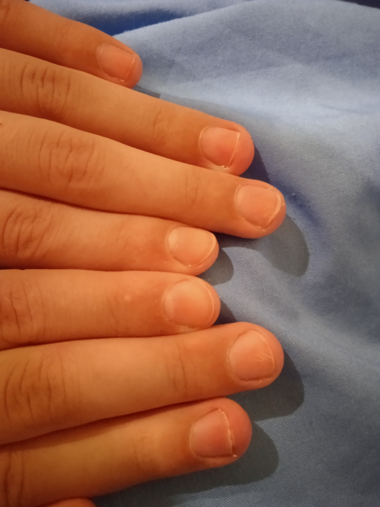 О каких проблемах со здоровьем могут рассказать ваши ногти