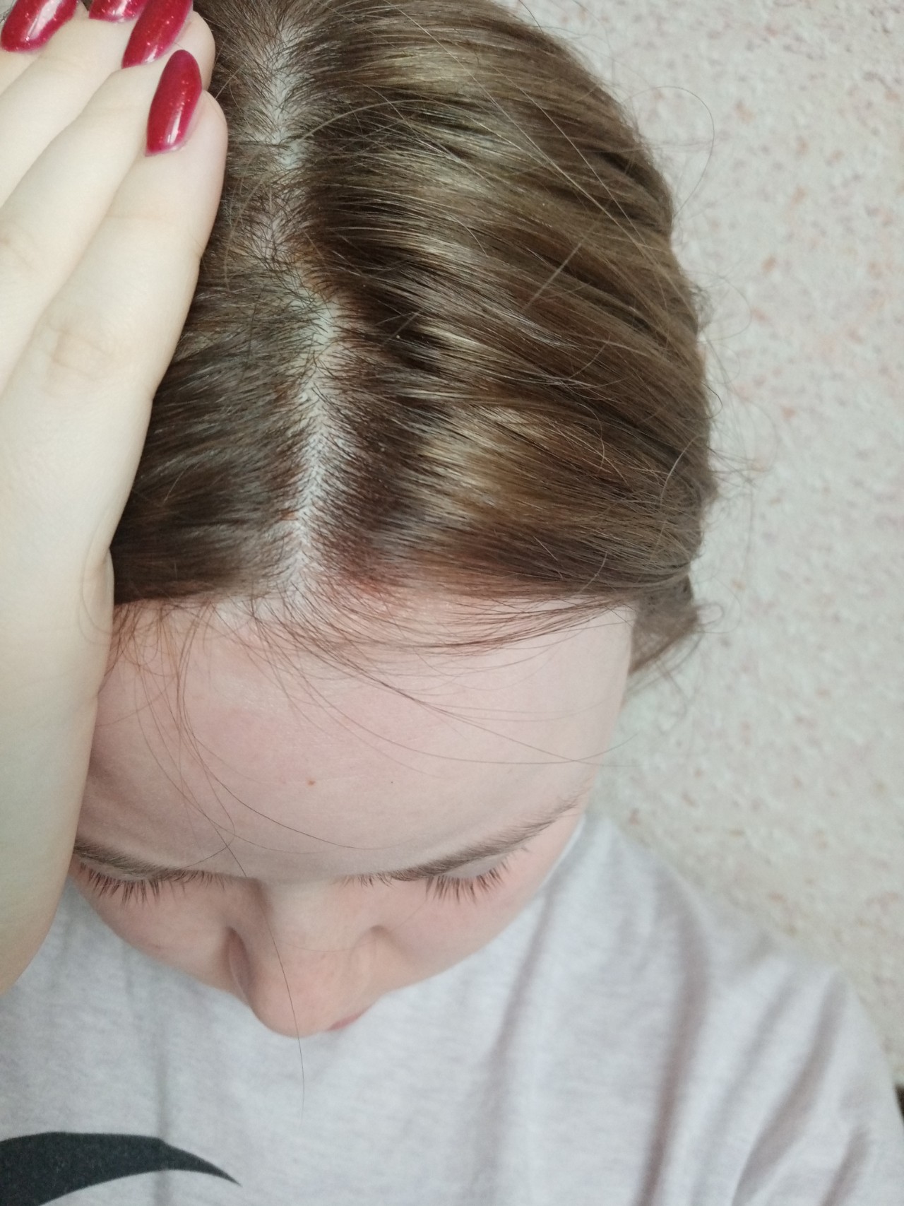 Аллергия на лак для волос фото