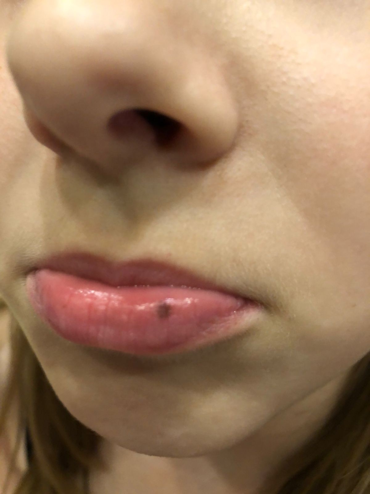 Пигментация вокруг губ