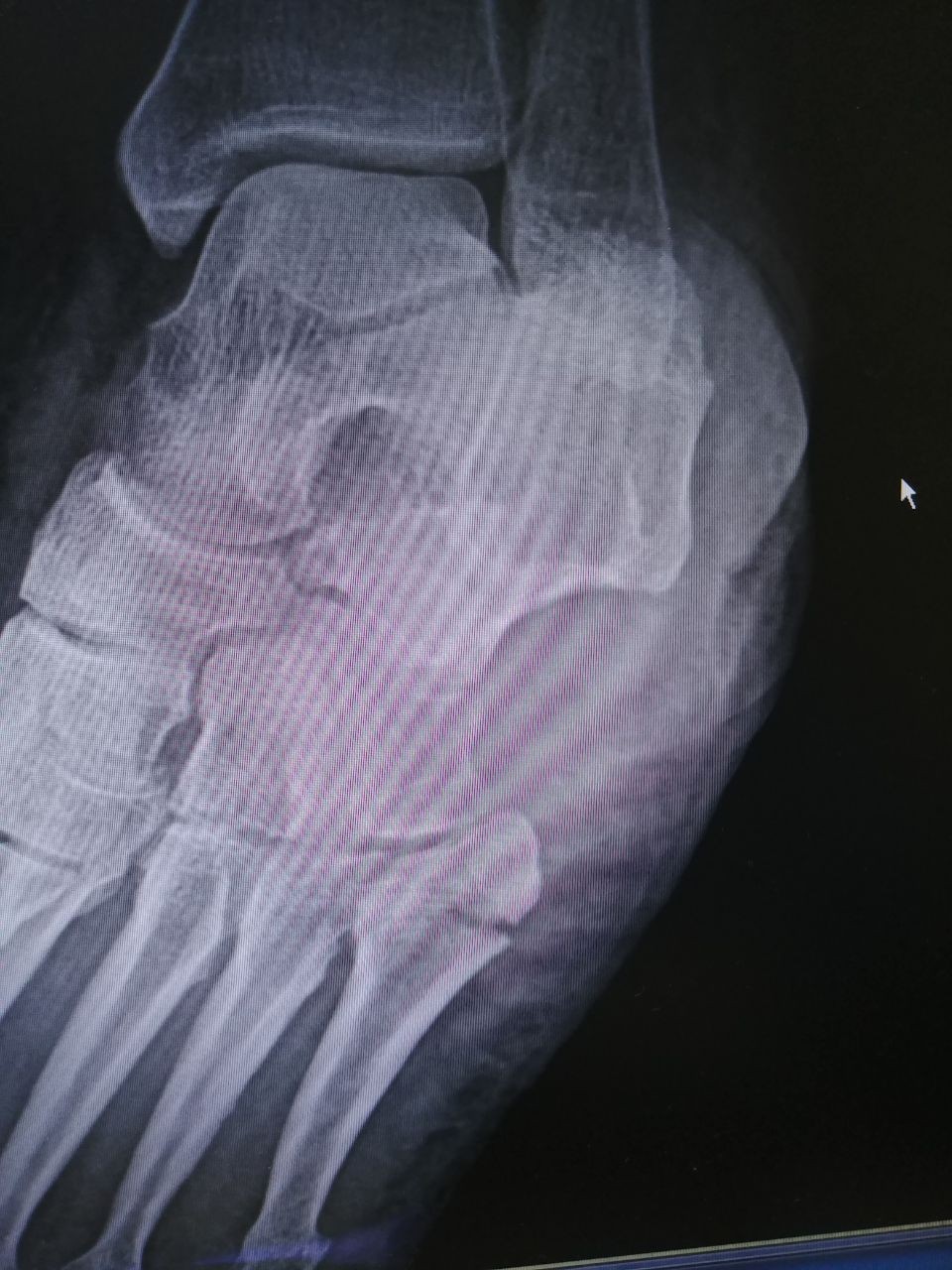 Перелом джонса 5 плюсневой кости фото