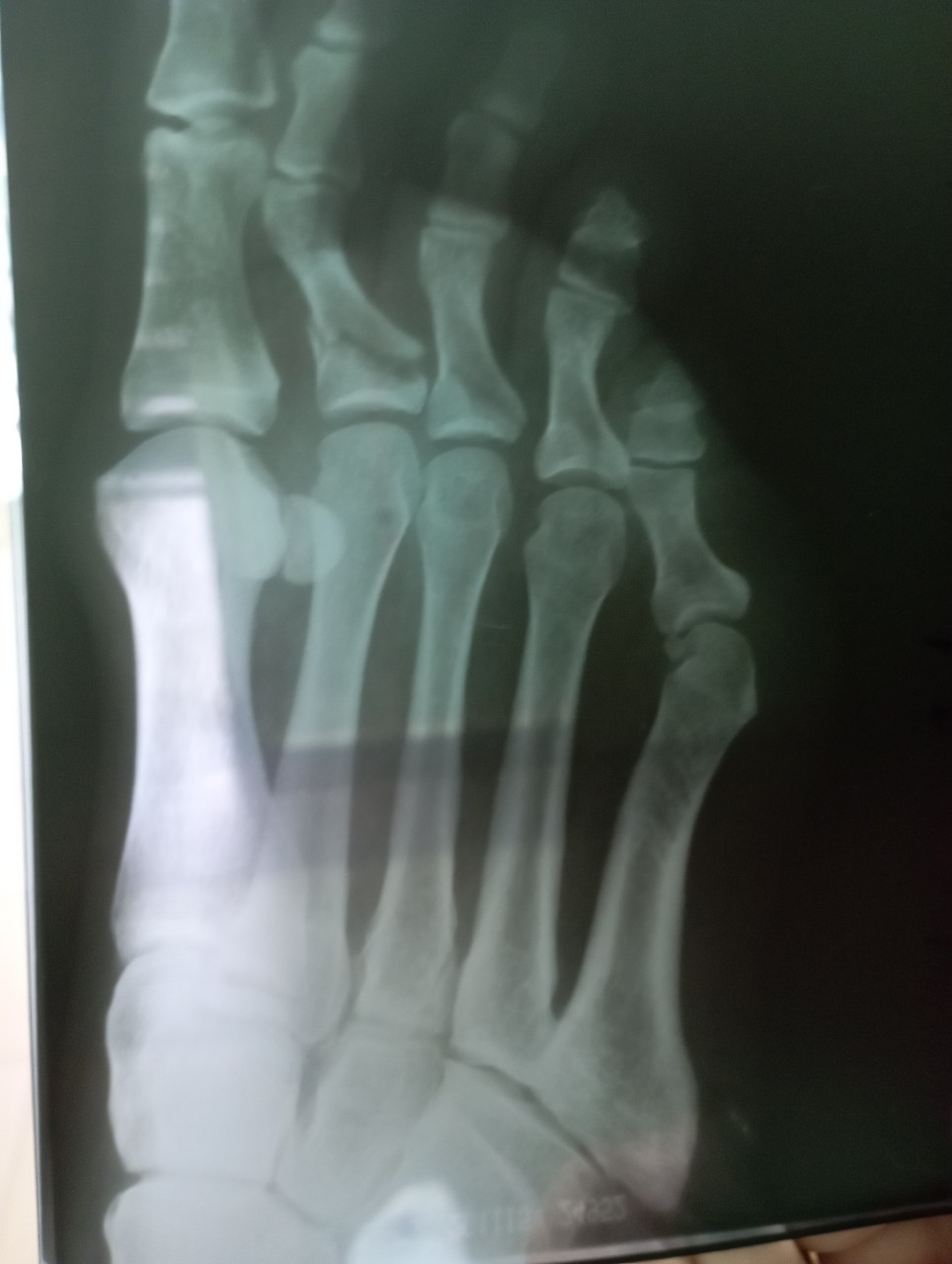 Открытый перелом фаланги. Снимок перелома фаланга на ноге детский. Остеопоротические переломы фаланг.