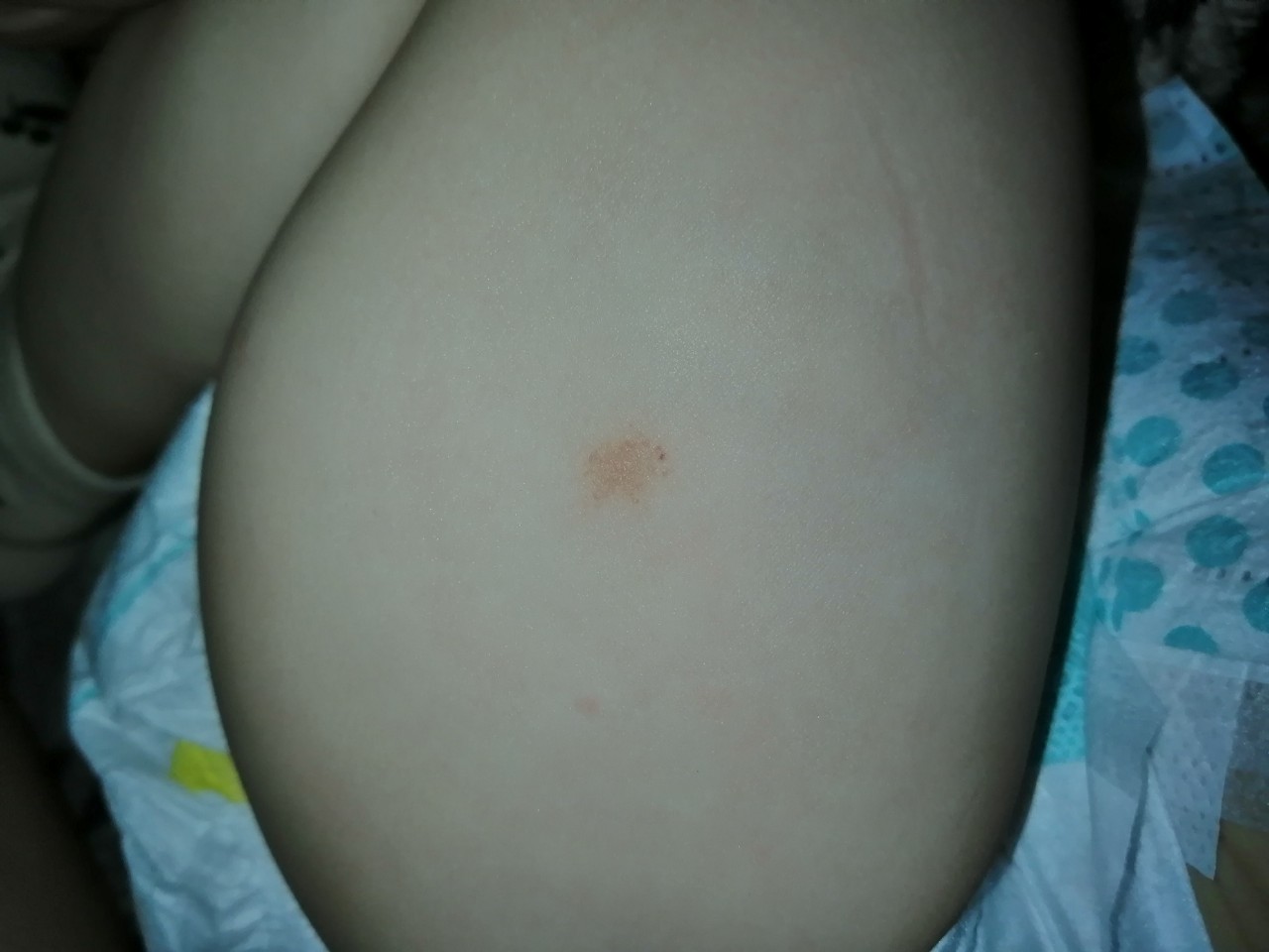 красное пятно на груди во время беременности фото 74
