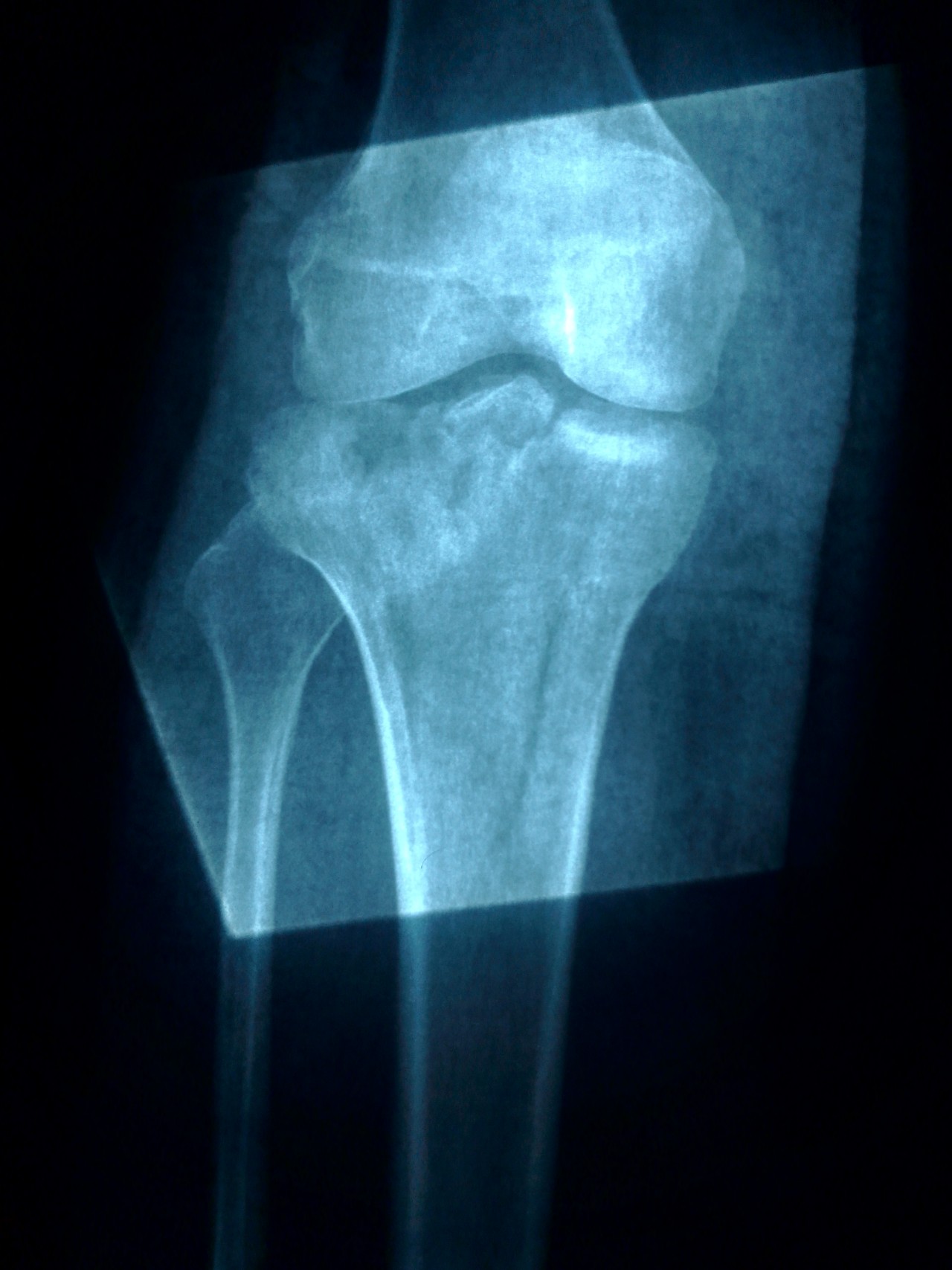 Мыщелок ноги. Рентген большеберцовой кости. Перелом мыщелка большеберцовой рентген. Перелом мыщелка большеберцовой кости. Перелом плато большеберцовой кости.