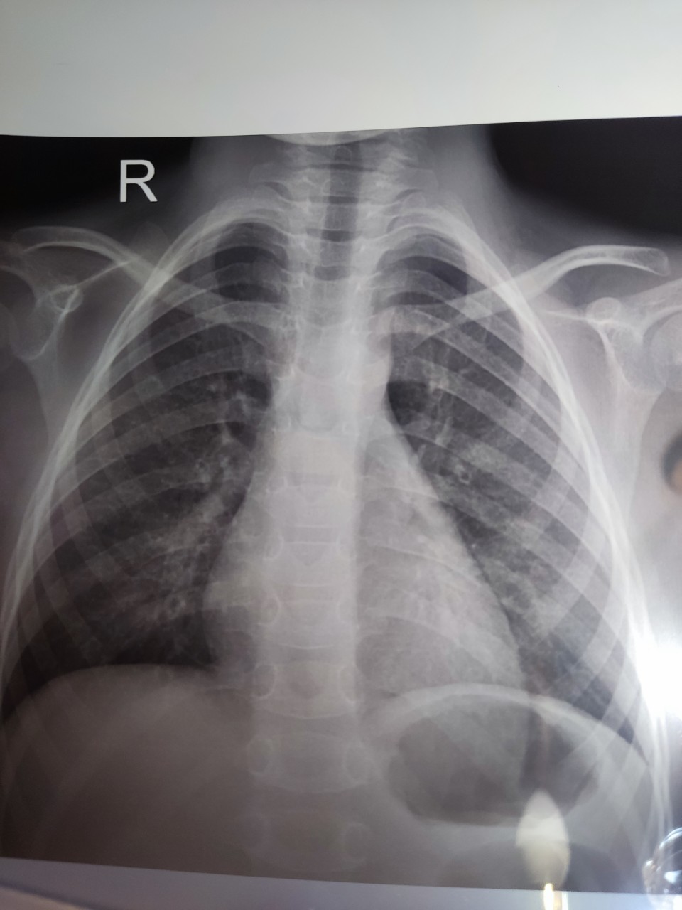 силиконовая грудь на рентгене фото 87