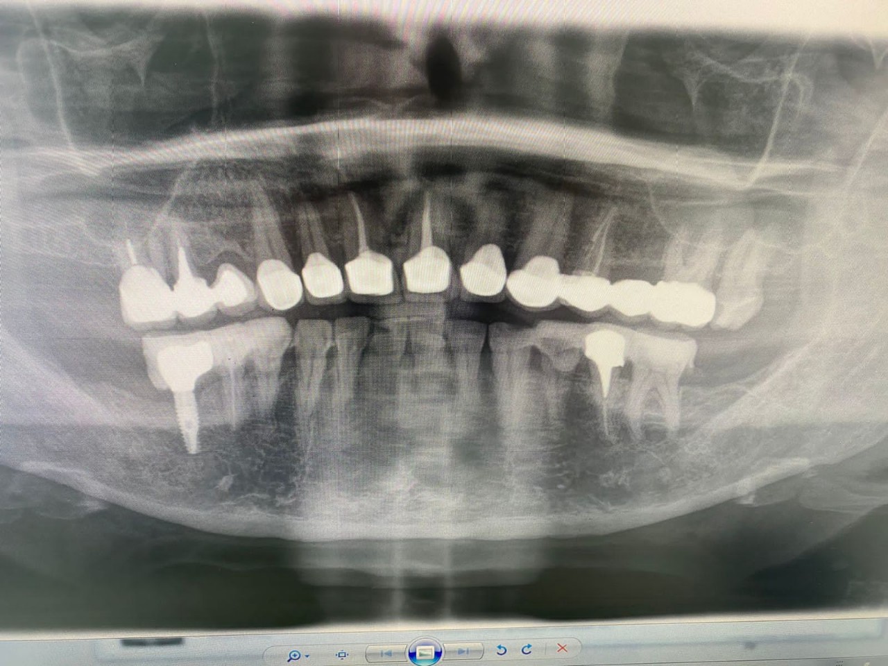 Зуб семерка верхний. Рентген верхней семерки. Зуб 7 верхний скошен.
