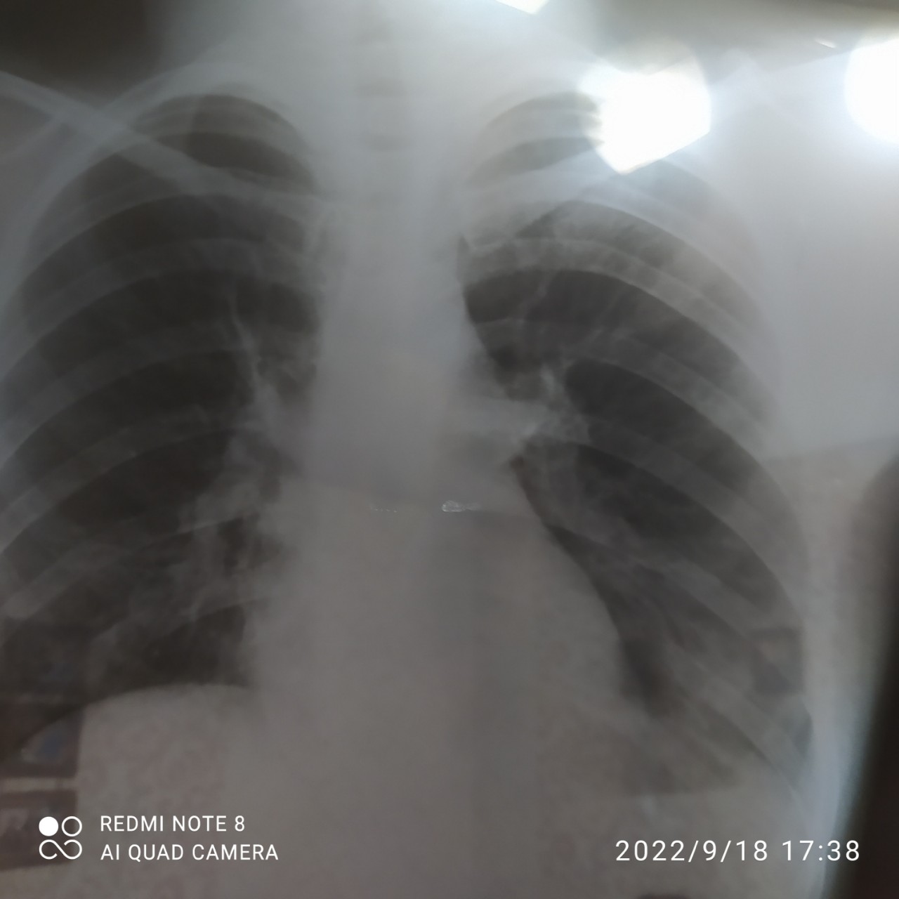Поражение лёгких на рентгене