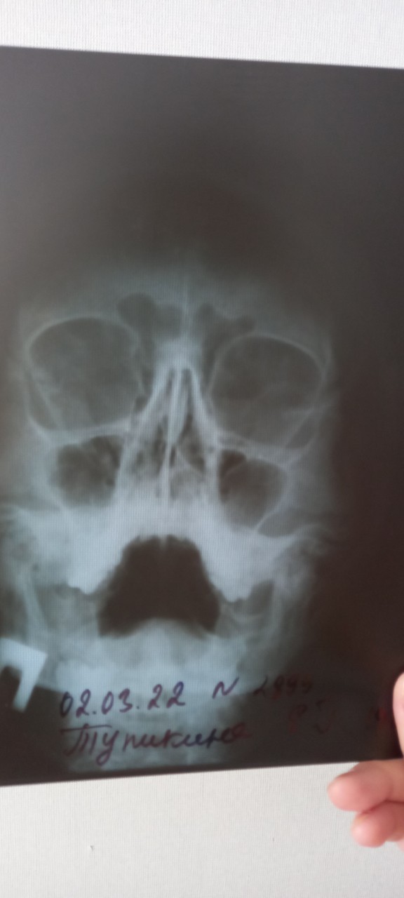 Как выглядит фронтит на рентгене фото