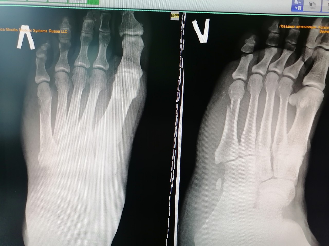 Закрытый перелом костей плюсны карта вызова