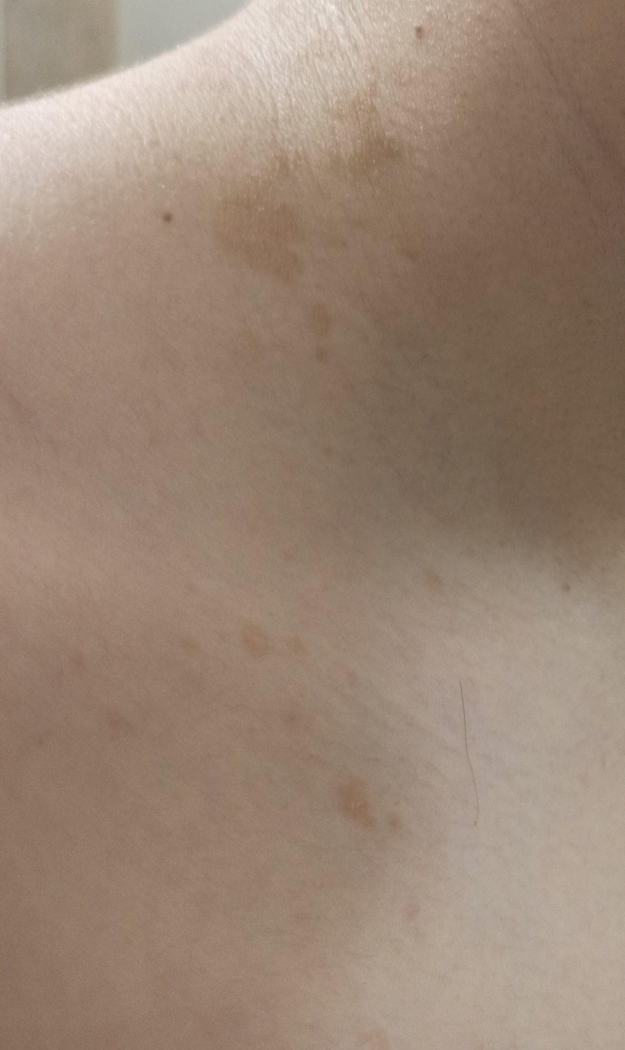 светло коричневые пятна на груди у женщин фото 77