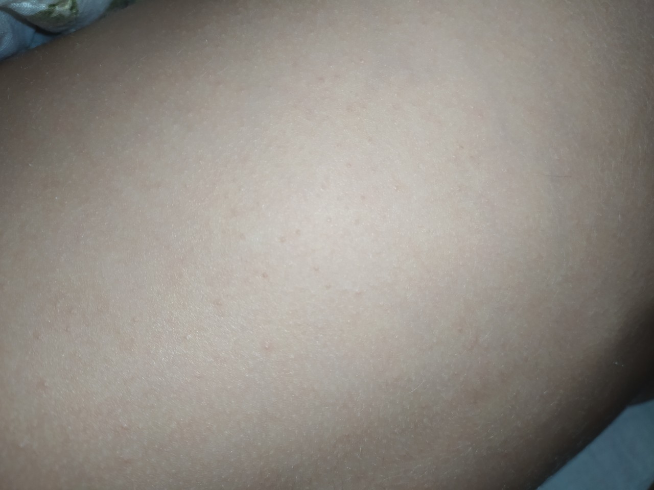 сыпь на спине и груди при беременности фото 66