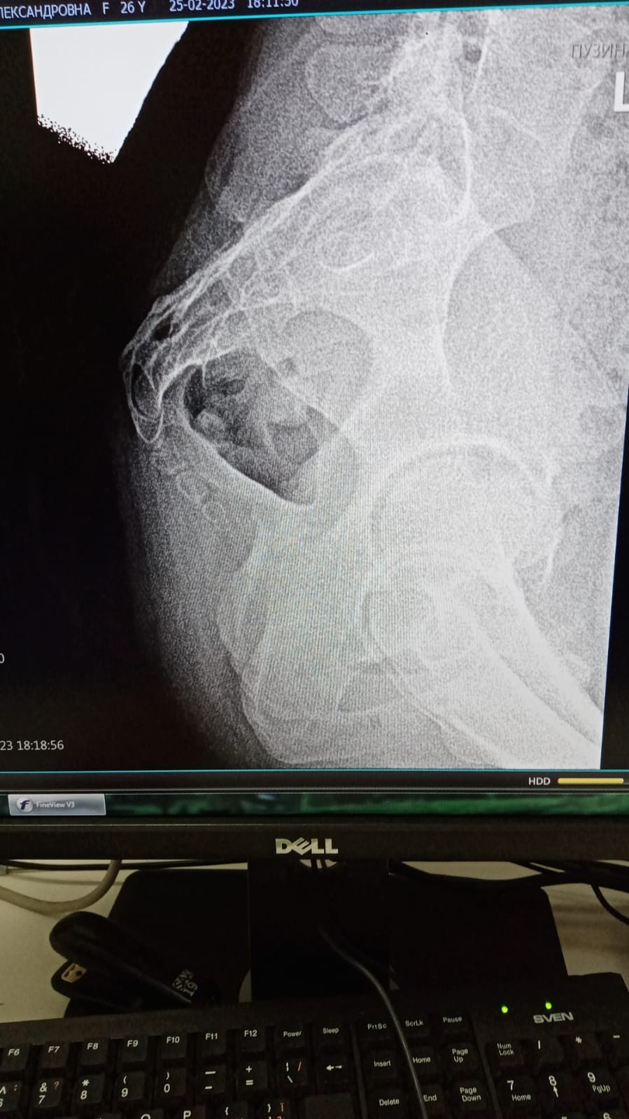 Перелом копчика фото рентген