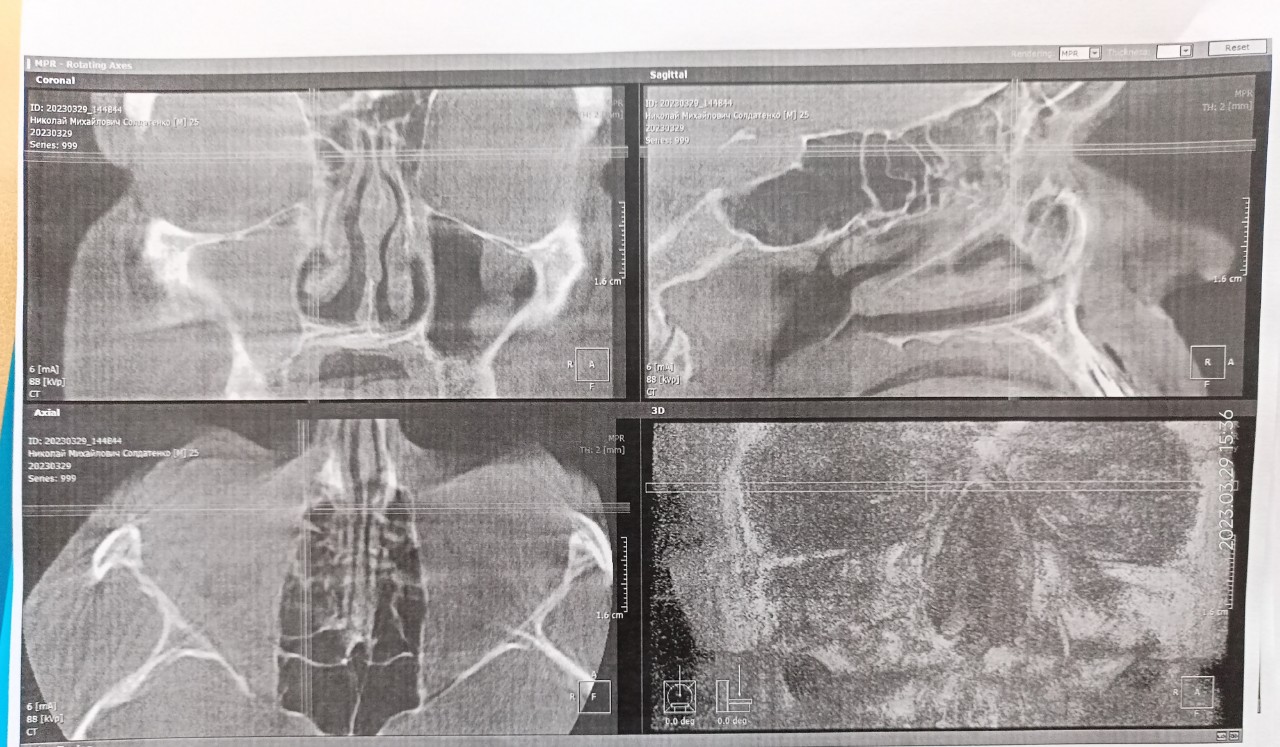 Кт околоносовых пазух картинки