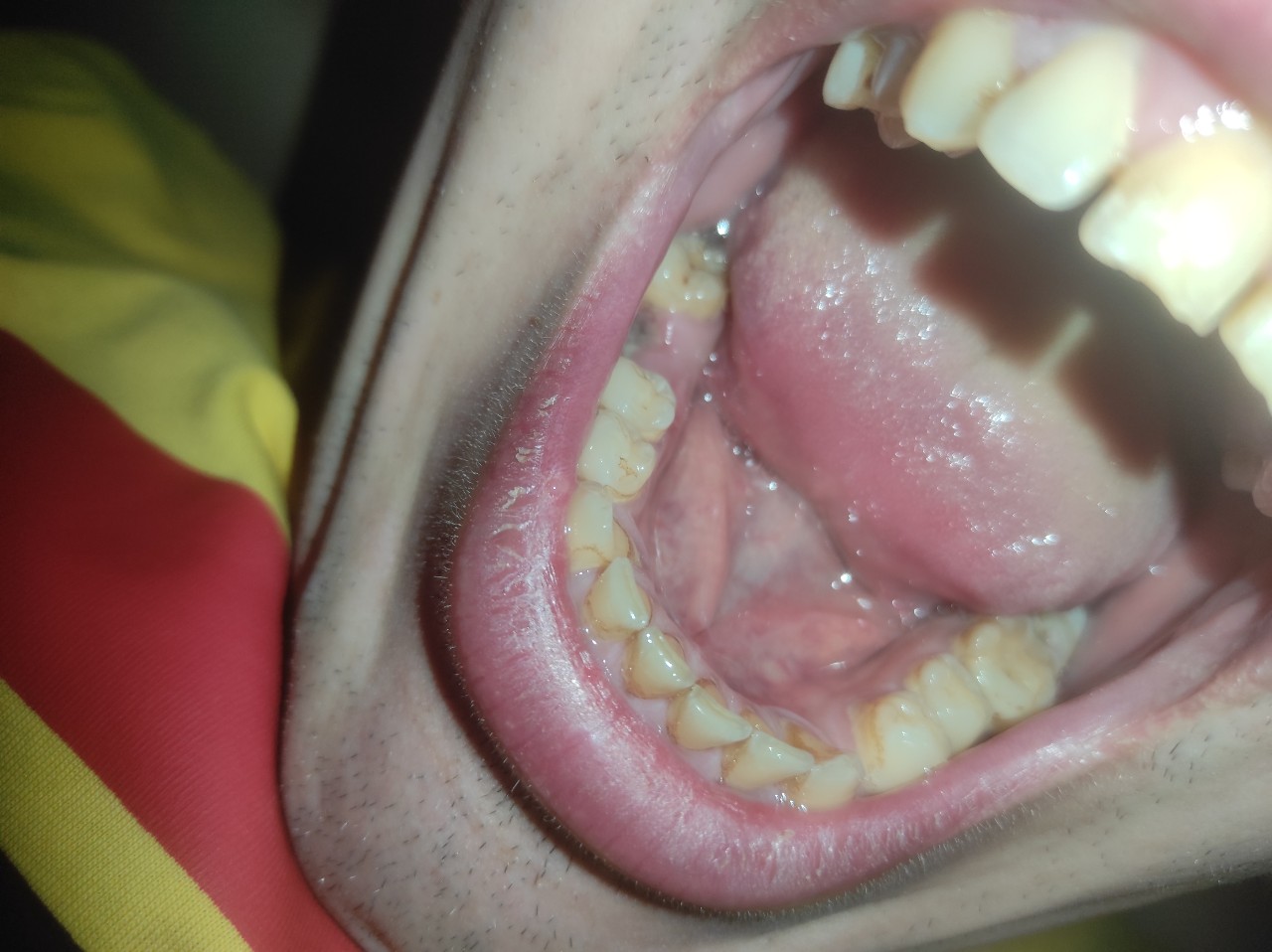 Лунка на 5 день после удаления зуба фото