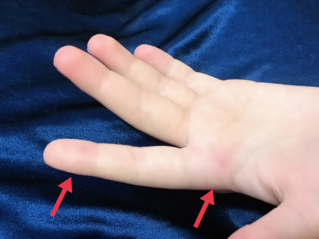 Ноет левая пальцы рук. Указательный палец левой руки фото. Покалывание в указательном пальце левой руки. Отсутствие указательного пальца на левой руке. Указательный палец левой руки порезан.
