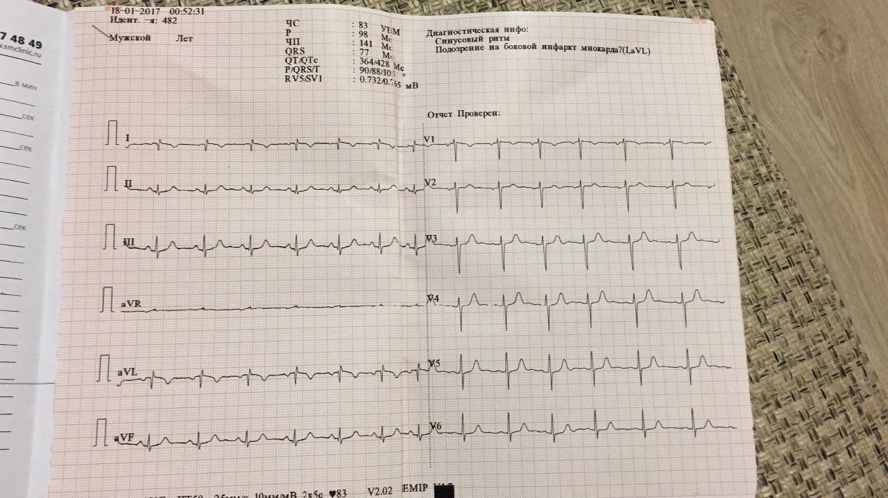 Перед экг. ЭКГ листок. ЭКГ перед операцией.