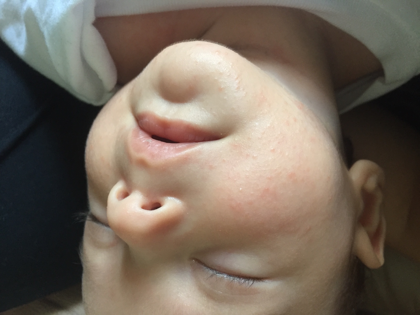 Сыпь на лице у новорожденного