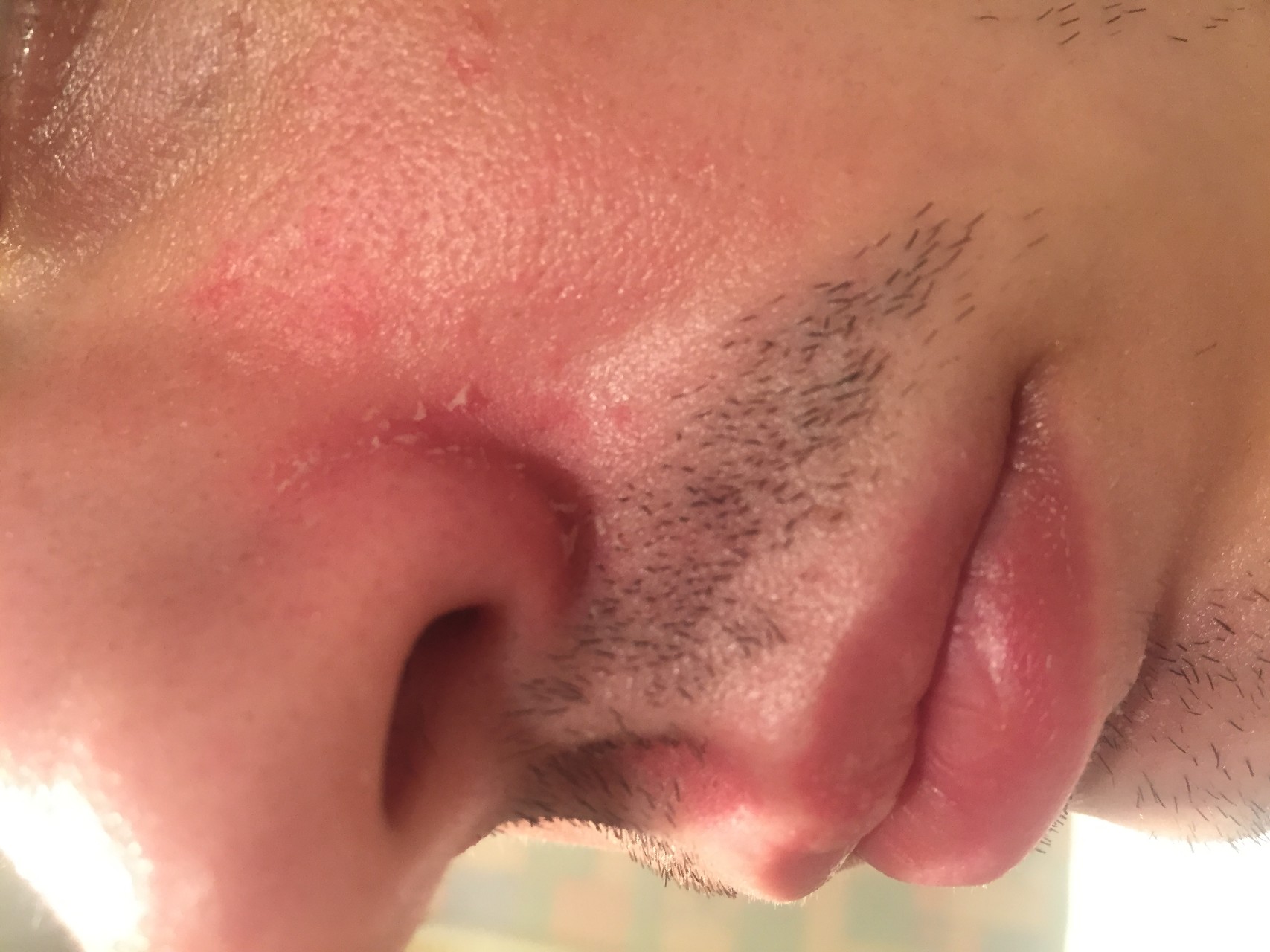 Заболевания, вызывающие покраснение и шелушение носа