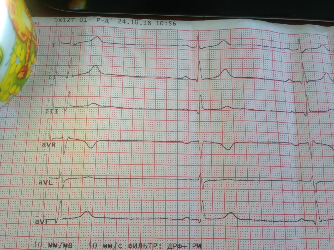 Сколько действительно экг. ЭКГ подростку. Кардиограмма подросток. Помогите расшифровать ЭКГ. ЭКГ В покое.