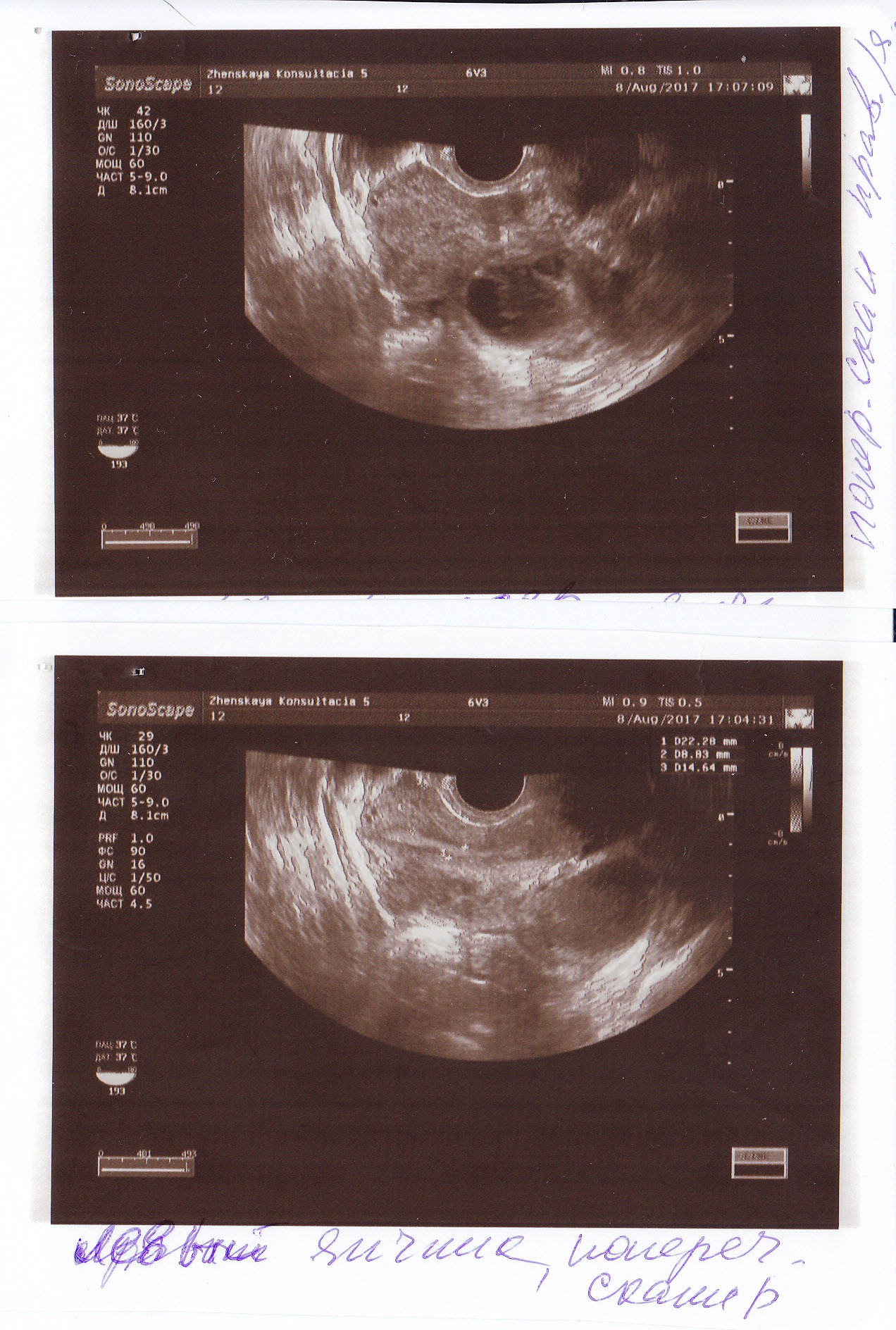Эндометриоз яичника фото
