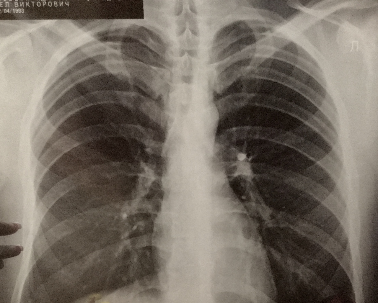Снимок здоровых легких у человека на рентгене фото