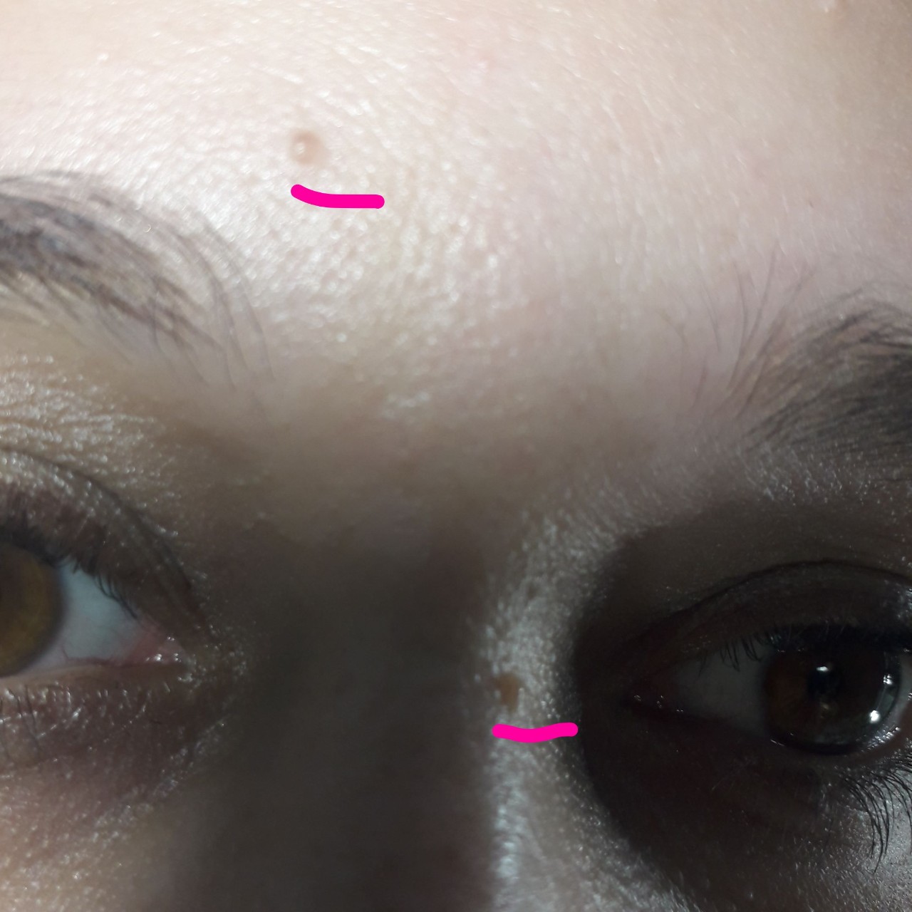 Телесного цвета образования на лице - Вопрос дерматологу - 03 Онлайн