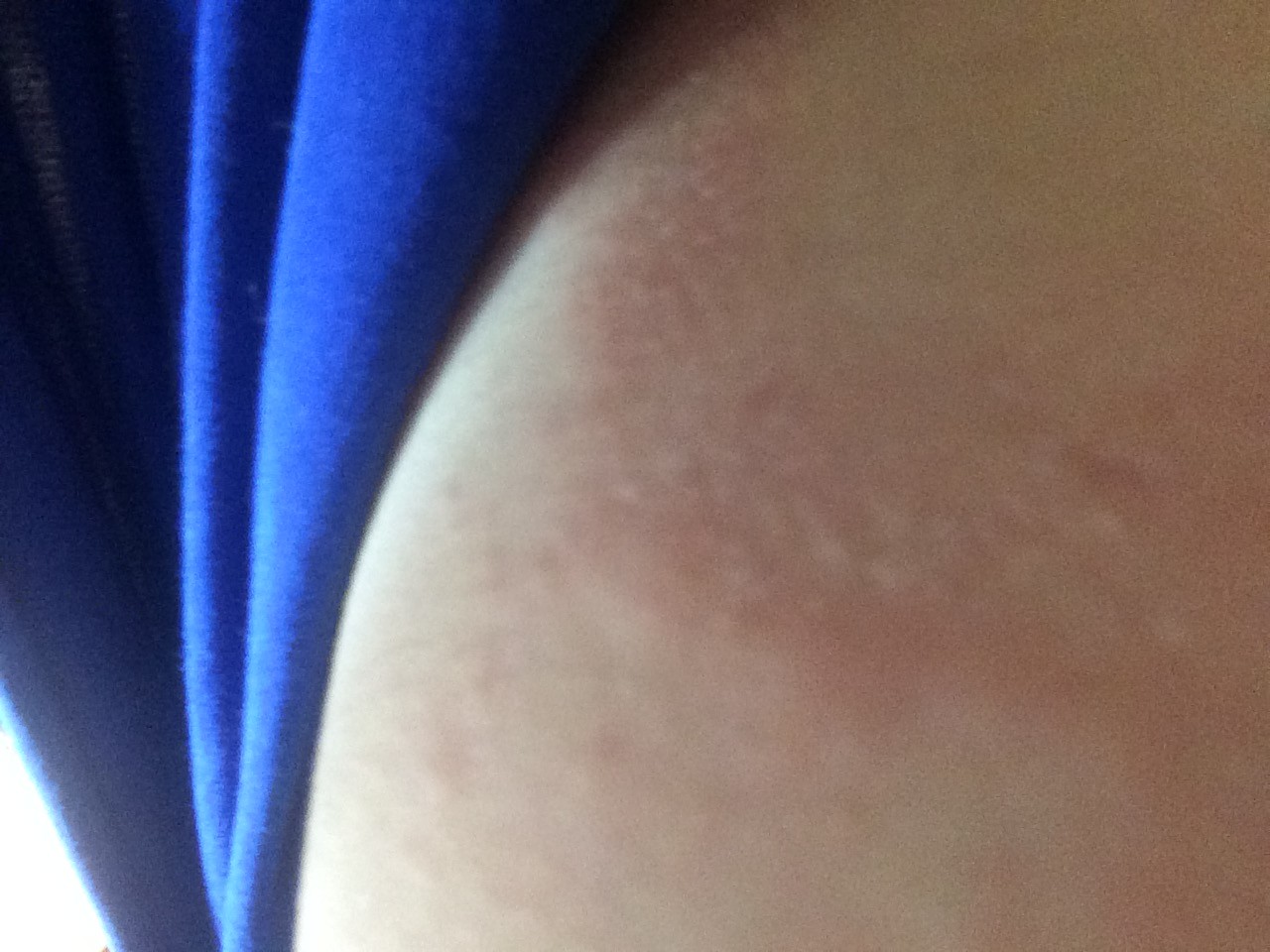 аллергия на груди у беременной фото 79