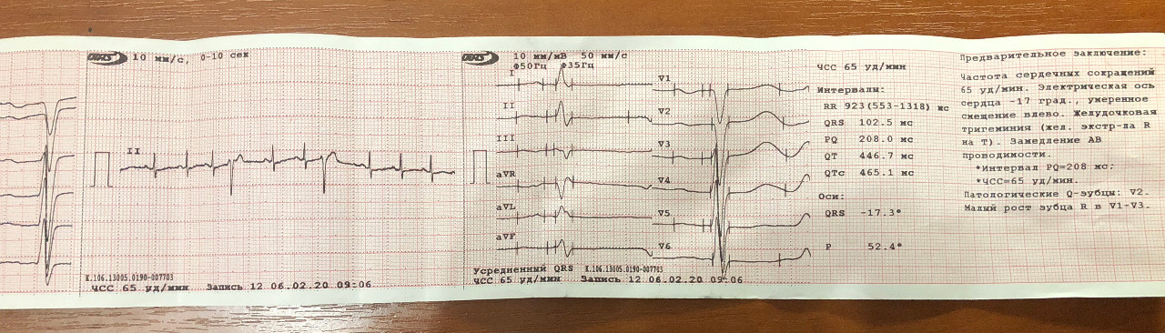 Экг v1 v2 v3