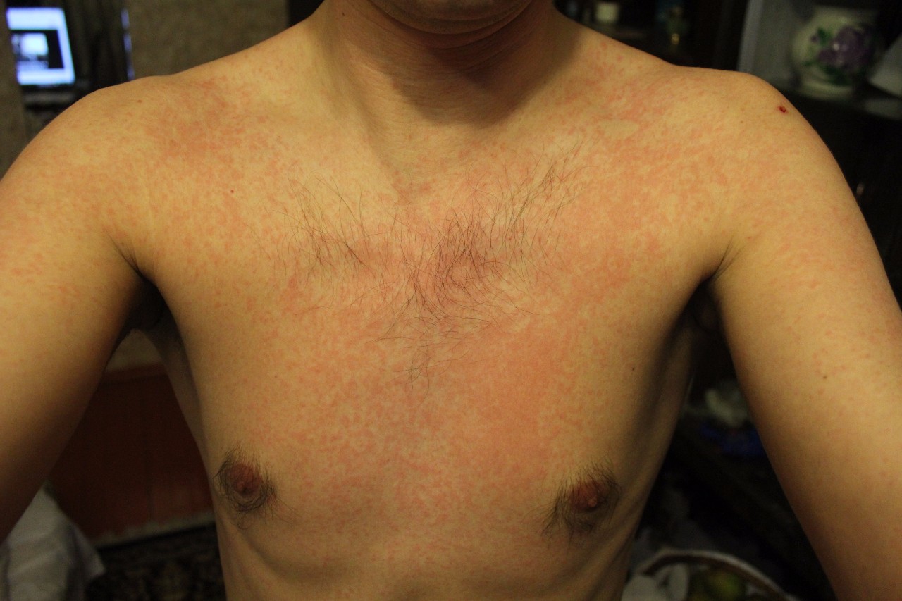 красное уплотнение на груди у мужчин фото 110