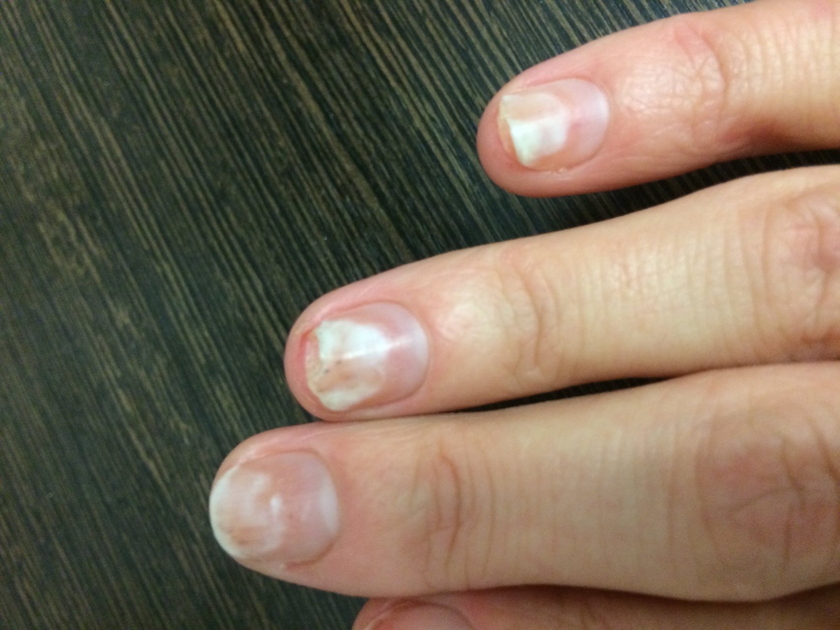 Проблемы с ногтями после гель лаков фото