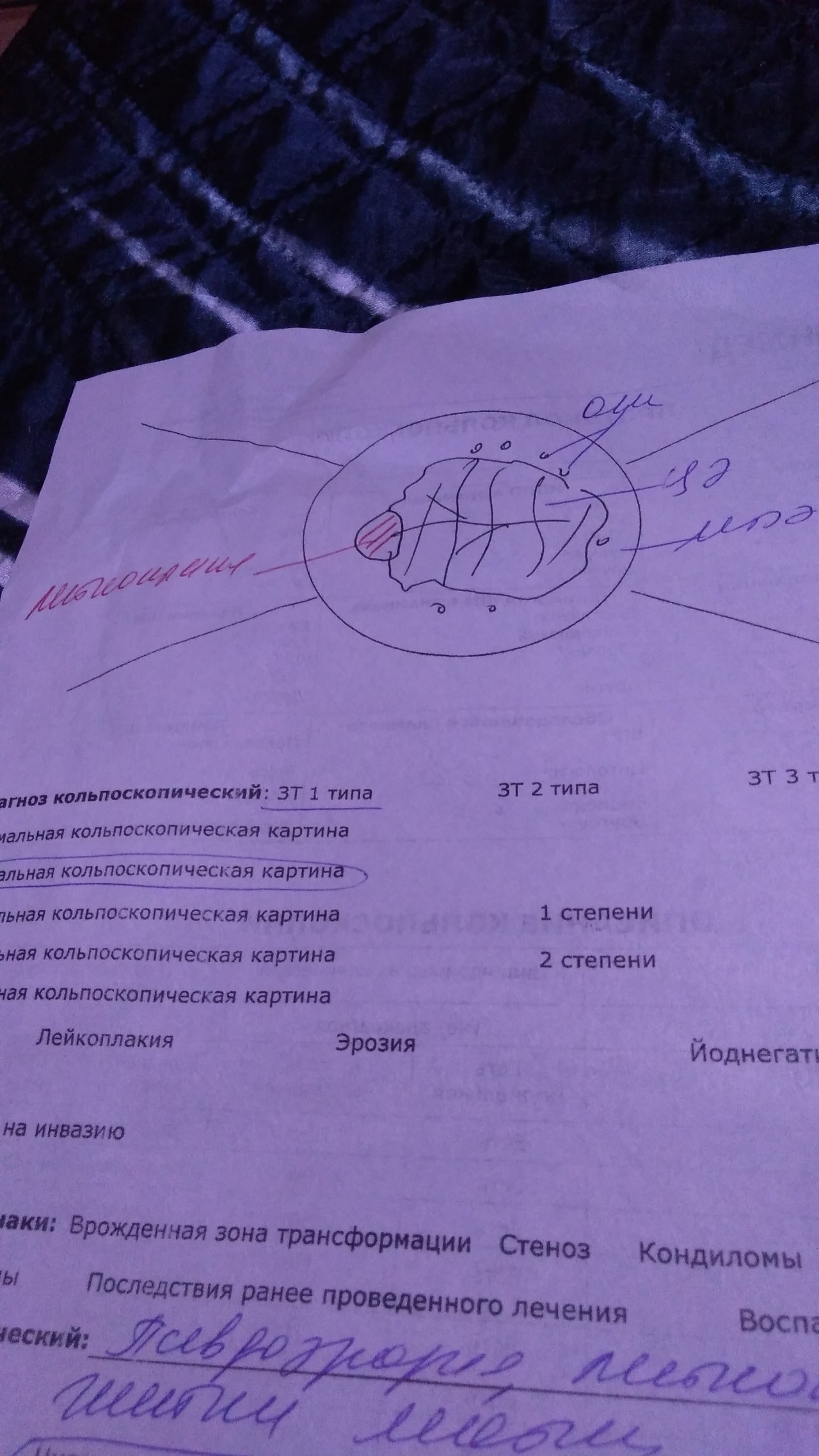 Что значит аномальная кольпоскопическая картина 2 степени