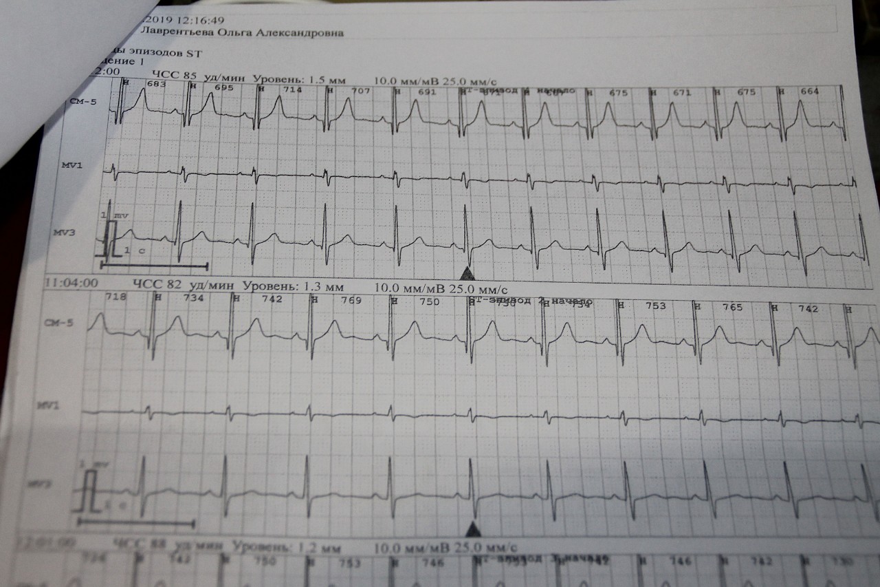 Экг при тахикардии фото