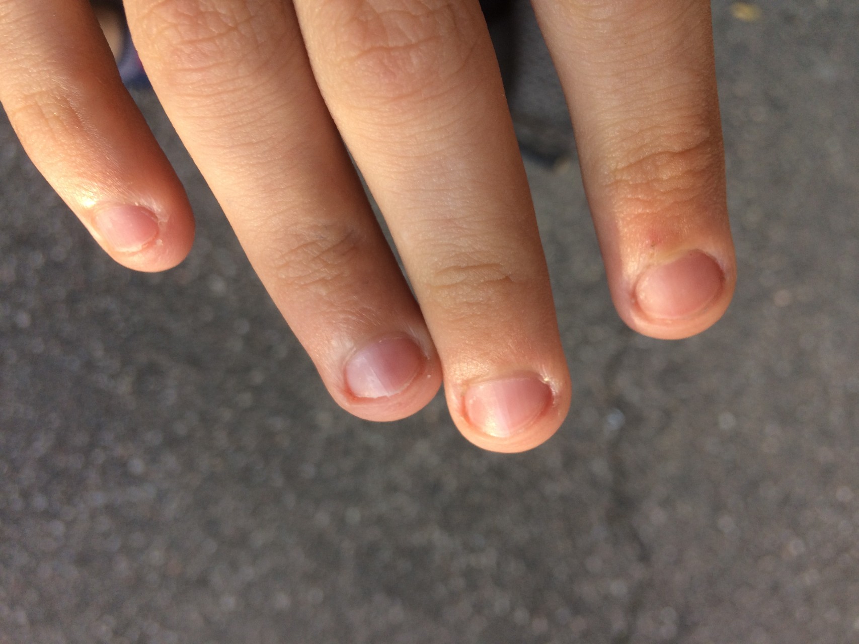 Пол пальчика. Микотическая лейконихия. Широкие ногти. Ногти маленькие. Широкие ногти на руках у мужчин.