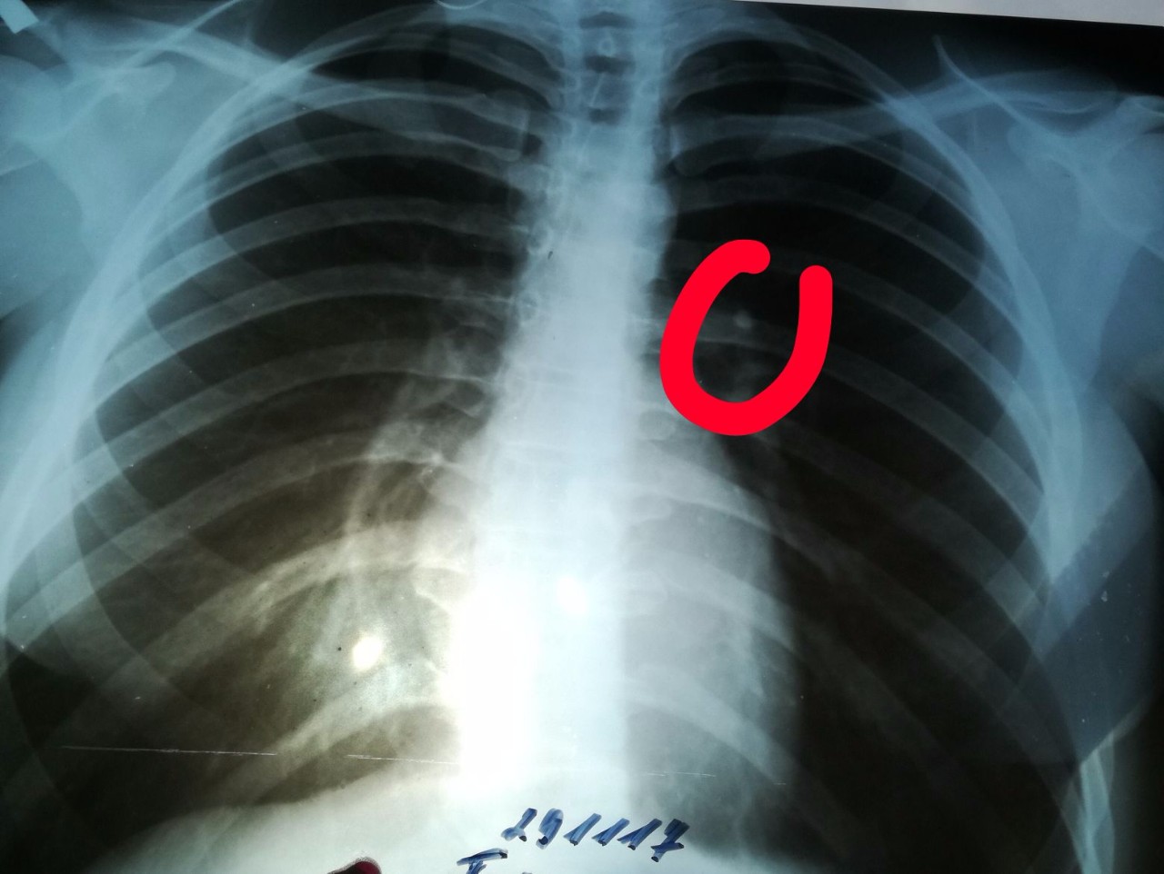 Трещина в организме. Рентген грудной клетки перелом ребер. Поднадкостничный перелом ребра. Перелом 8 ребра справа рентген. Рентген перелом ребра слева.