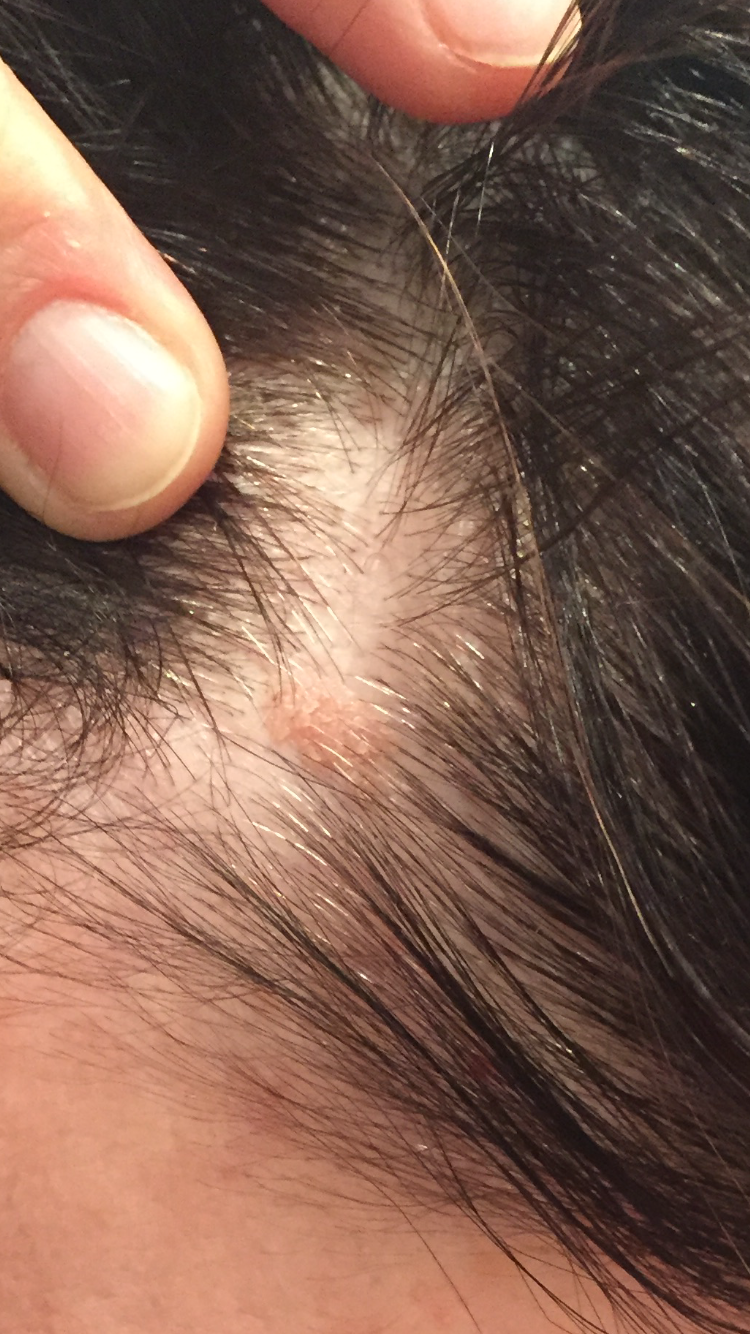 Заболевания кожи и волосистой части головы (Микроспория), Горноуральская районная поликлиника