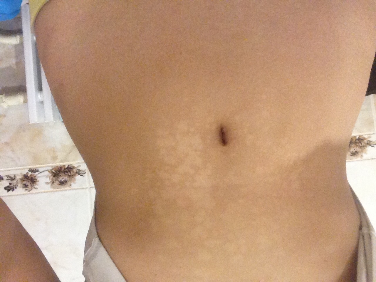 коричневые пятна на груди при беременности фото 12