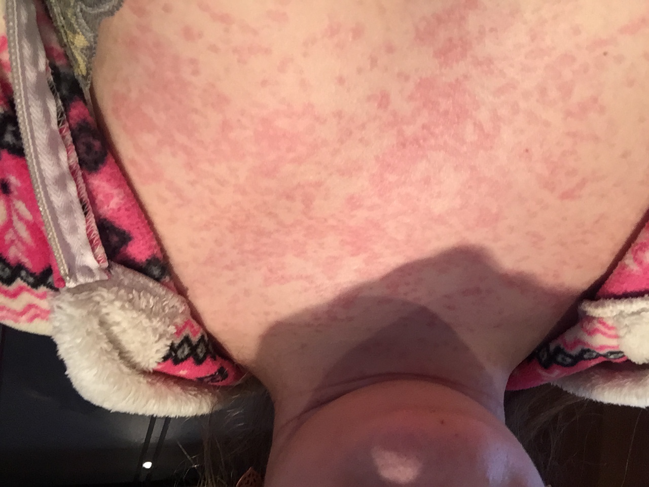 аллергия на грудях у кормящей мамы фото 35