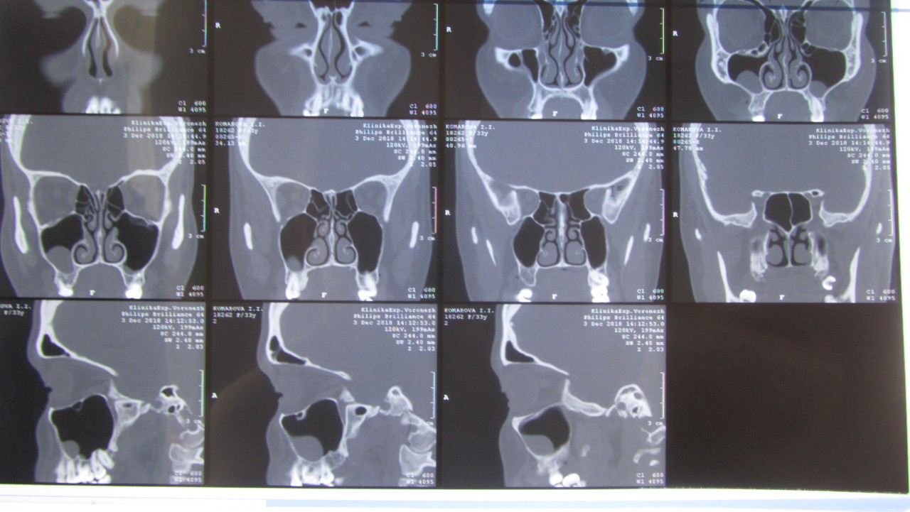 Киста левой верхнечелюстной пазухи что это. Одонтогенный синусит кт. Одонтогенный гайморит на кт. Одонтогенная киста верхнечелюстной пазухи мрт. Грибковый одонтогенный синусит кт.