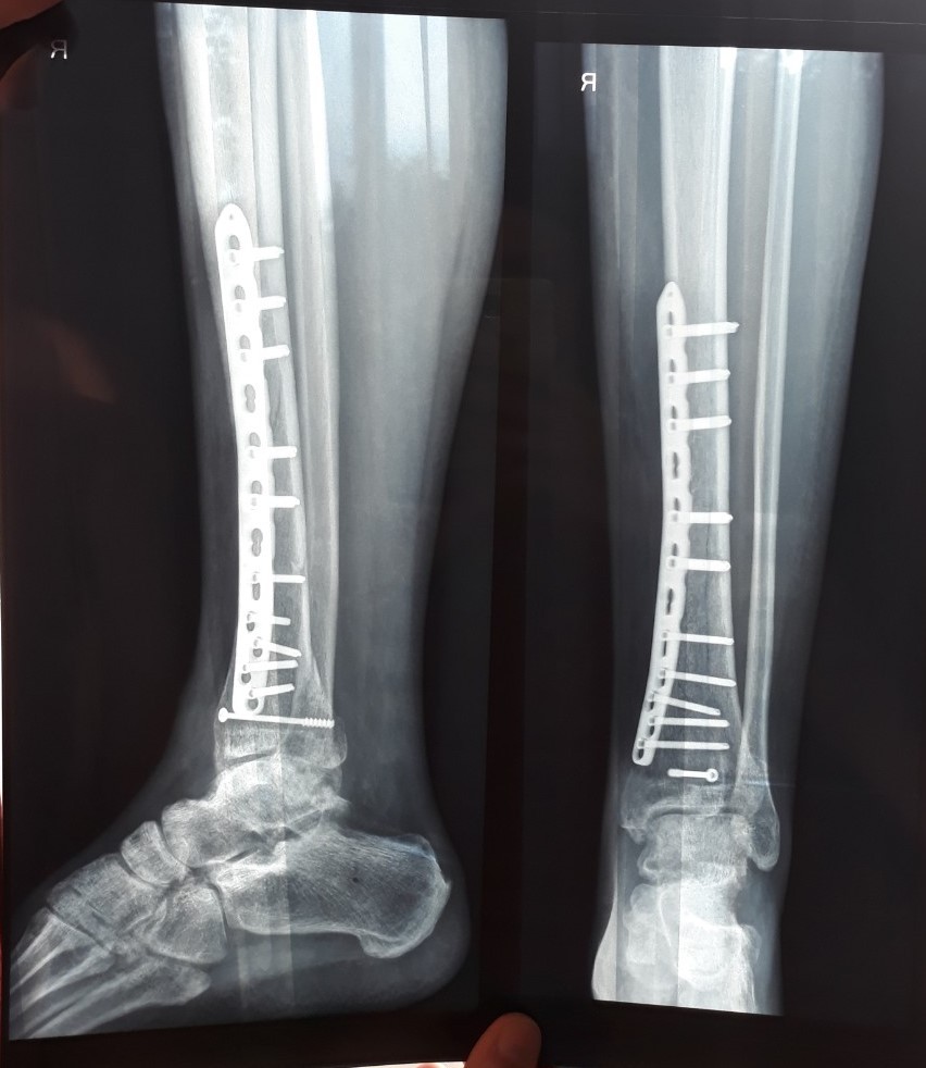Титановая пластина. Пластина при переломе большеберцовой кости. Титановая пластина на берцовую кость. Перелом малой берцовой кости шина.