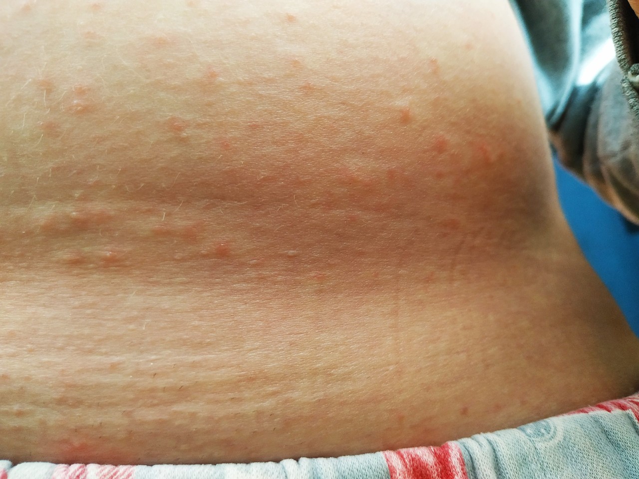 красная сыпь на груди во время беременности фото 70