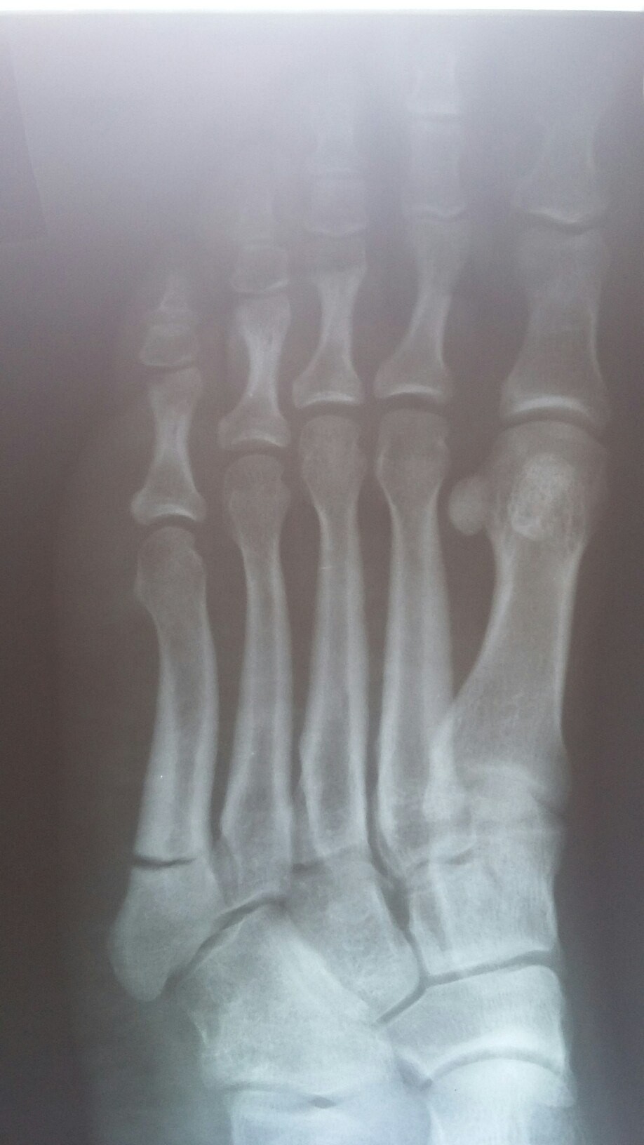 Перелом плюсневой кости стопы фото ноги