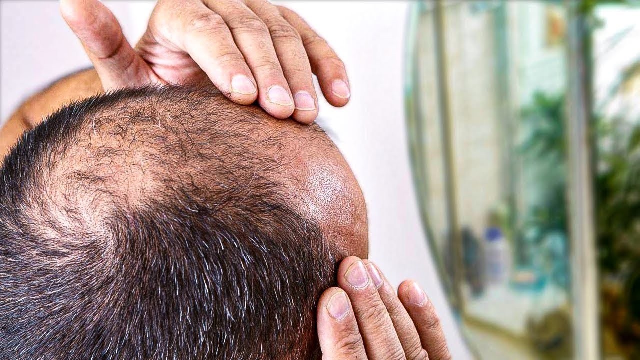 Рост волос на голове у мужчин